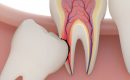 vancouver Wisdom Tooth Removal