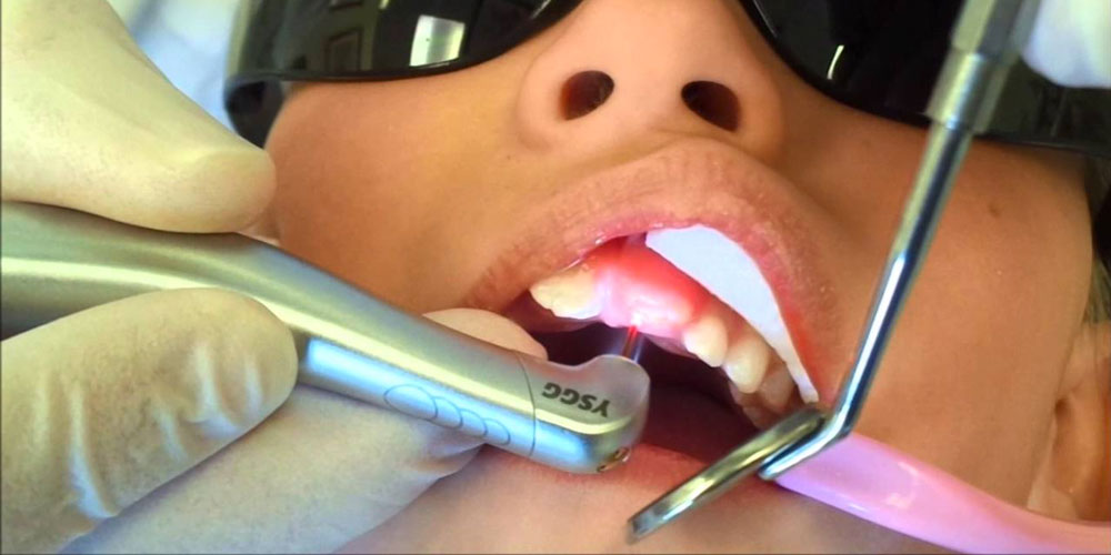 laser dentistry vancouver