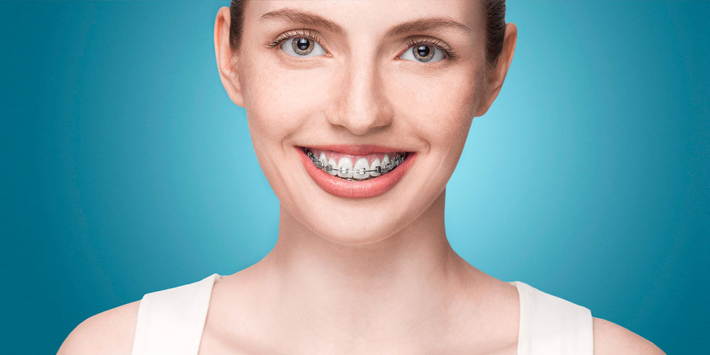 Translucent Cosmetic Braces  Greater Vancouver Orthodontics