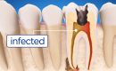 root canal vancouver