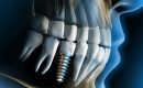vancouver dental implants