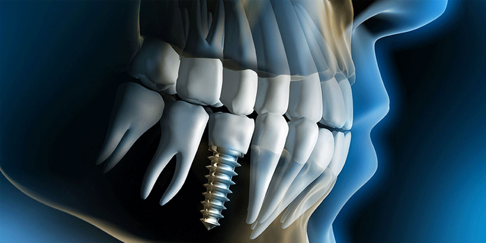 vancouver dental implants