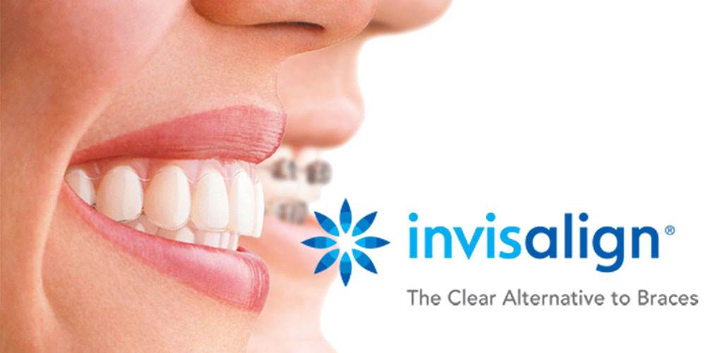 vancouver dentist invisalign