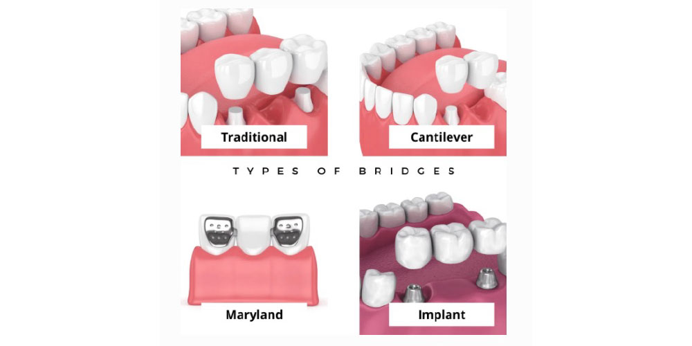 dental bridges