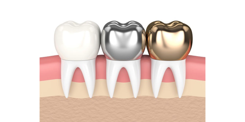 dental crowns