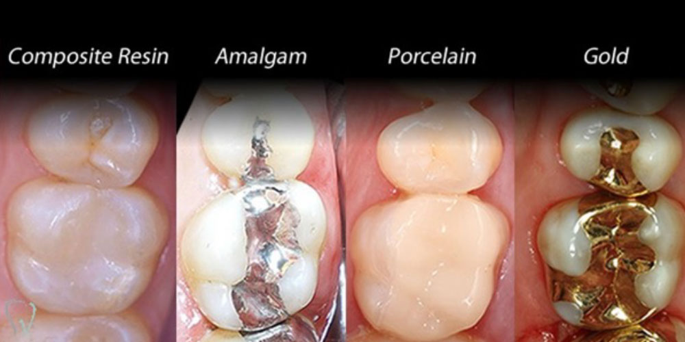 Tooth Fillings