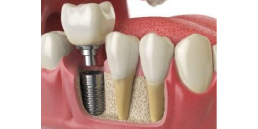 dental implants