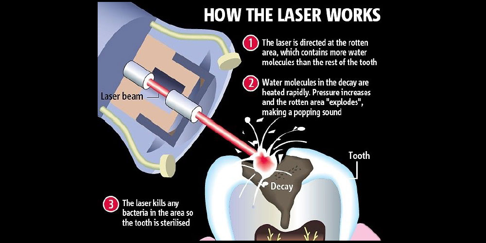 laser dentistry