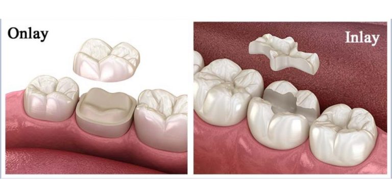 Inlays Onlays Mount Pleasant Dental Group