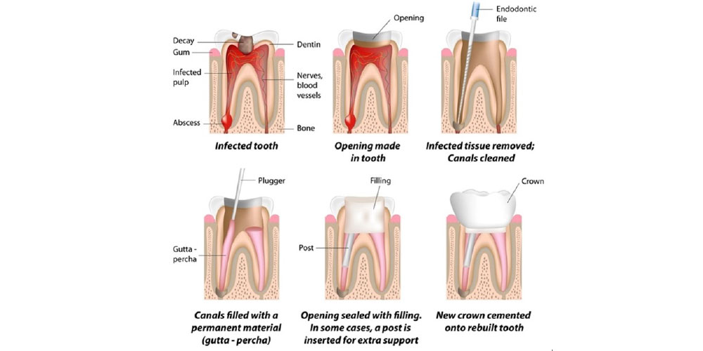 root canal