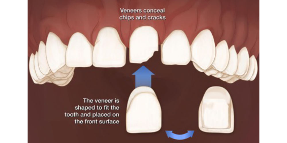 veneers